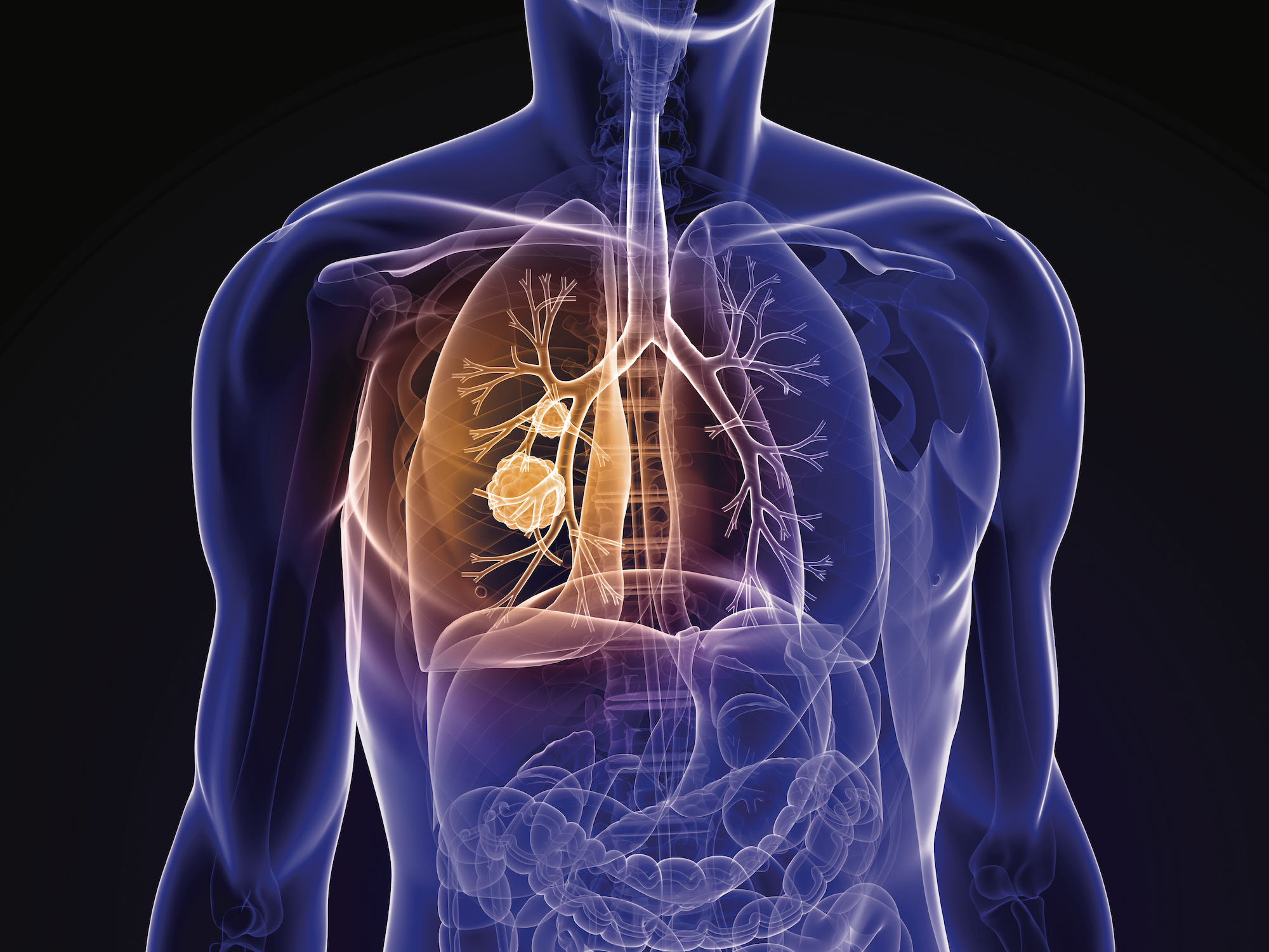 Managing Lung Cancer Patients Through the COVID-19 Pandemic : What to Know